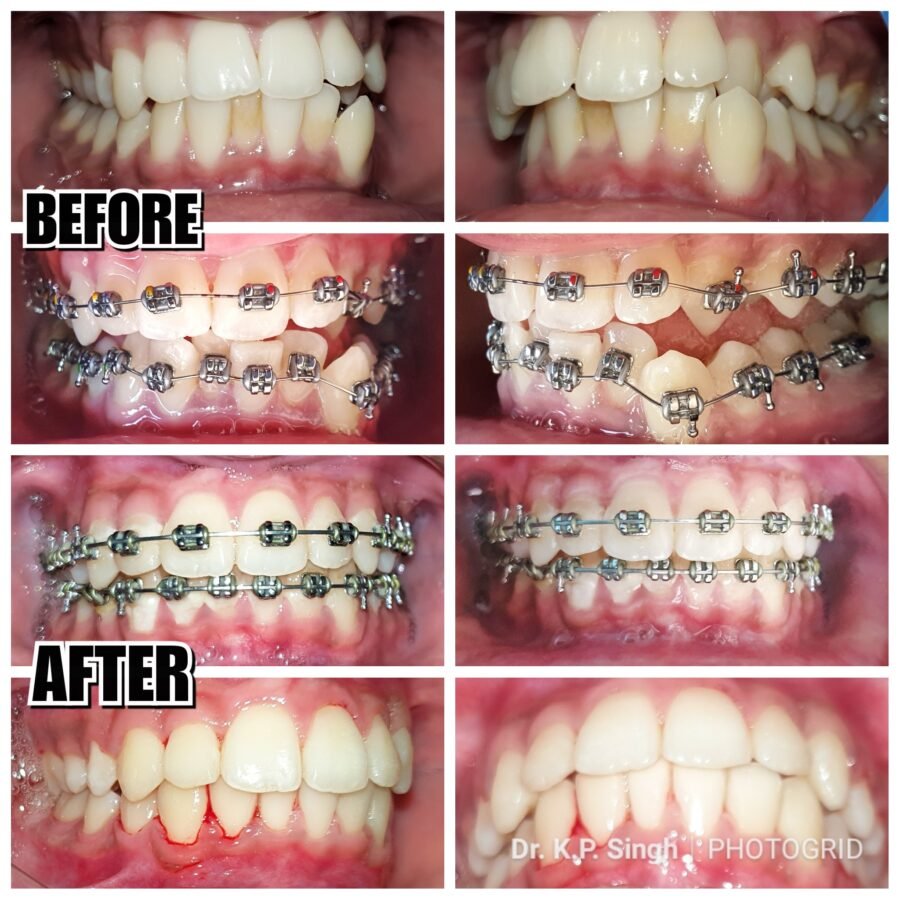 Straighten Your Smile with Confidence: Orthodontic Braces at JSM Dental Clinic