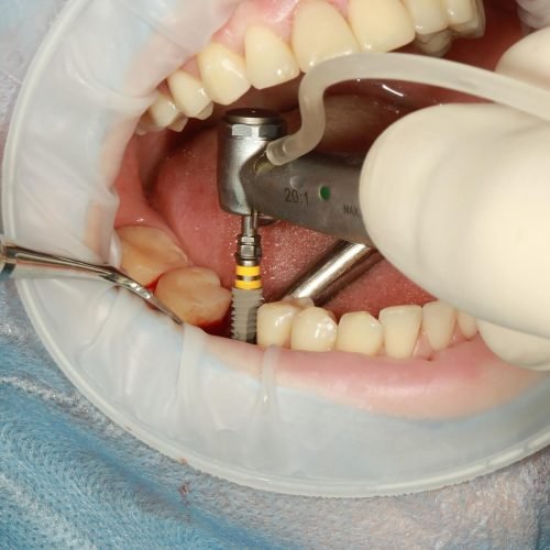 Smile Confidently Again with Dental Implants